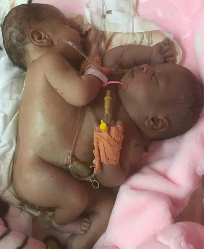 صورة للتوأمين الملتصقين، نشرها الإعلامي والمدون حبيب الله ولد أحمد على صفحته في فيسبوك